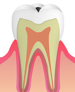 C1（エナメル質の虫歯）