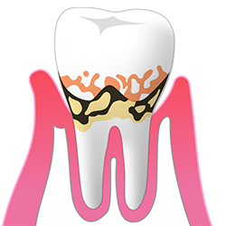 軽度歯周炎
