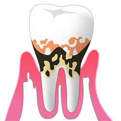 中等度歯周炎